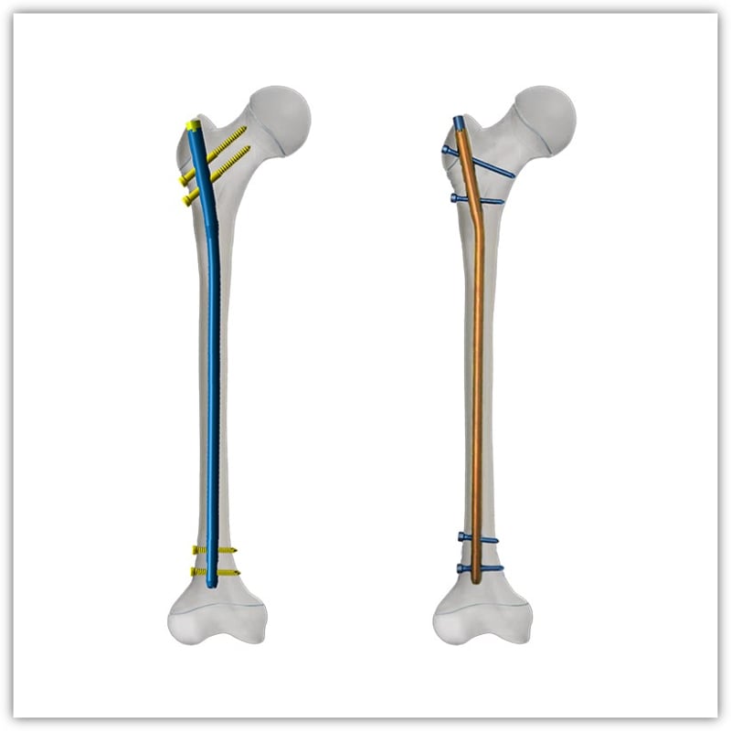 Intramedullary Pin & Nail Systems